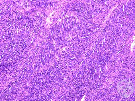 Fibrosarcoma Histology