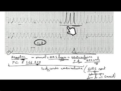 ECG trouble du rythme et fréquence prt 5 YouTube