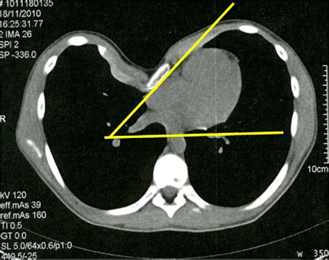 Figure 2 From Minimally Invasive Repair Of Pectus Excavatum Using The