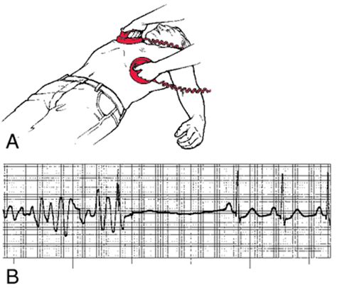 Defibrillation | definition of defibrillation by Medical dictionary