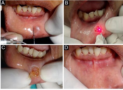 Mucocele Removal