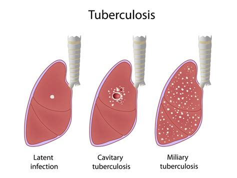 Tuberculosis (TB) Symptoms And Causes | Styles At Life