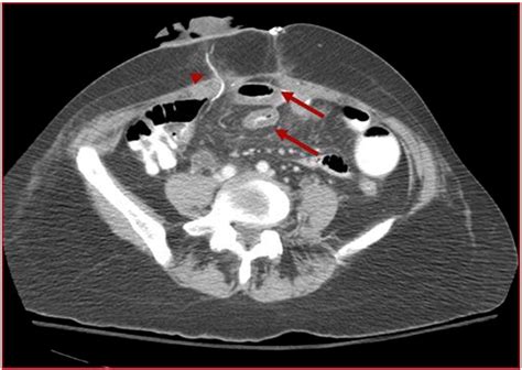 Diversion Ahead Imaging Appearance Of Urinary Diversions And