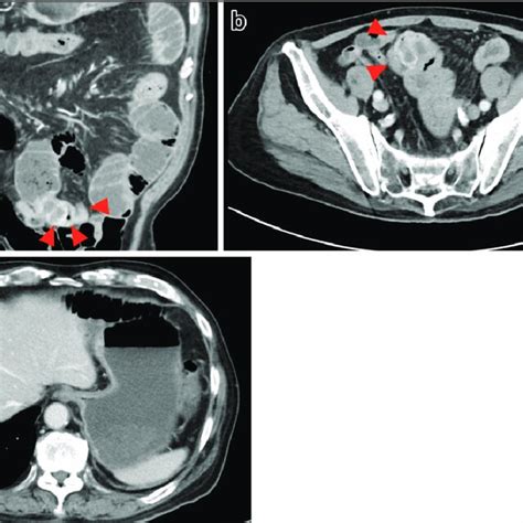 Contrast Enhanced Abdominal Ct At Diagnosis Showed A Mass Of 50 Cm In Download Scientific