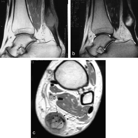 Sagittal T1w A Sagittal T2w B Axial T1w C Images Show T1