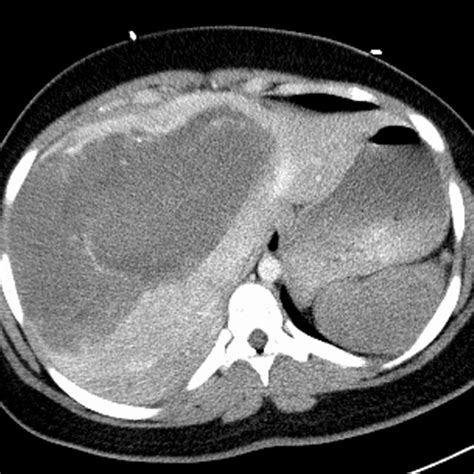 Mesenteric angiogram prior to transplant. Mesenteric angiogram ...