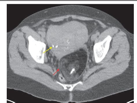 Figure 2 From Ovarian Squamous Cell Carcinoma Arising From Mature