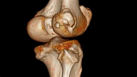 Femur Lateral Epicondyle Fracture Youtube