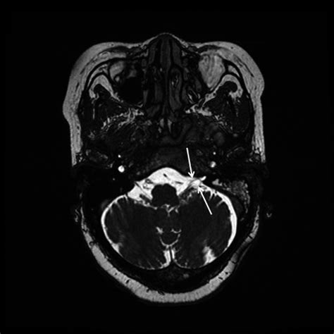 T2‐weighted Thin‐slice Fiesta Mri Sequence Shows Thickened Left