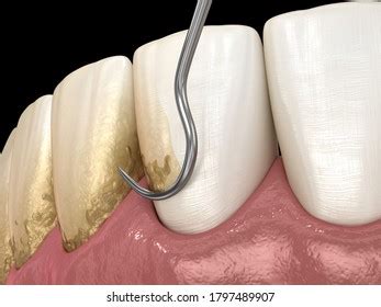 Open Curettage Scaling Root Planing Conventional Stock Illustration