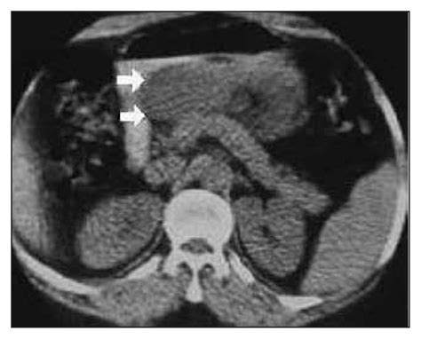 Cystic Lymphangioma Of The Lesser Sac Cjs