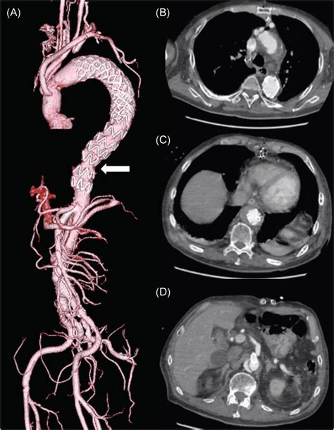 Postoperative computed tomography (CT). (A) An endograft was deployed ...