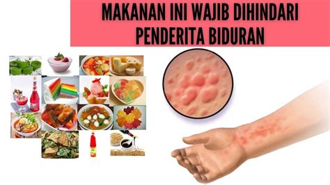 4 Jenis Makanan Yang Harus Dihindari Saat Biduran Youtube