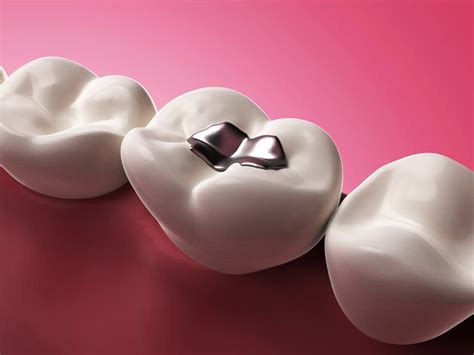 Amalgam Or Composite Fillings Pros And Cons Which Is Better