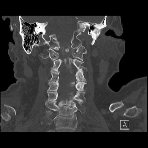 Fileodontoid Fracture Anderson And Dalonzo Type 3 Roy Camille Type 1 Radiopaedia 88042