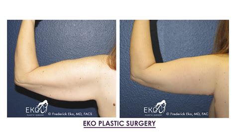 Arm Lift Surgery In Palm Desert CA Eko Plastic Surgery