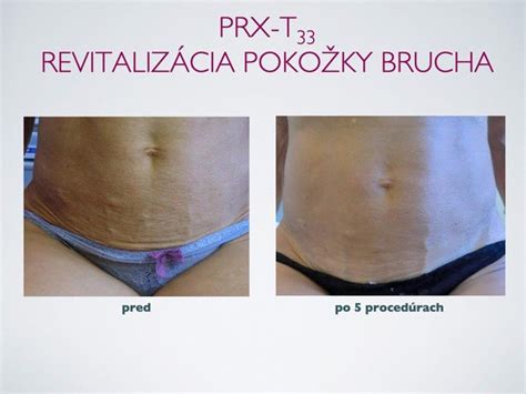 Biorevitalization Peeling PRX T33 Bratislava Vitality