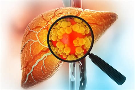 Per Quanto Tempo Si Pu Vivere Con L Epatite C Senza Saperlo