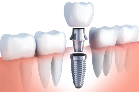 When To Worry About Dental Implant Procedure Pain After Surgery