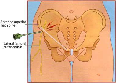 Meralgia Paraesthetica | e-algos