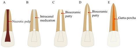 Bioengineering Free Full Text Bioceramics In Endodontics Updates