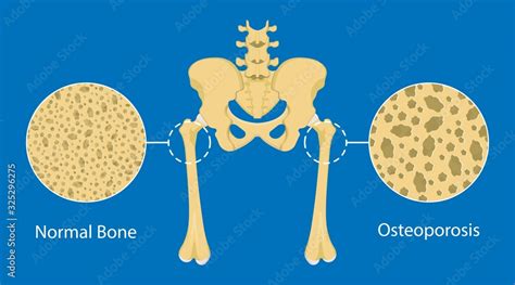 Bone Mineral Density BMD Osteoporosis Dual Energy X Ray Absorptionmetry