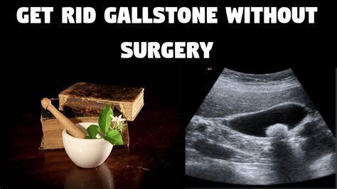 Get Rid Gallstone Without Surgery Gallstone Home Remedy Youtube