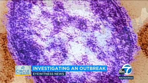 Measles outbreak proving costly to patients and government agencies - ABC7 Los Angeles