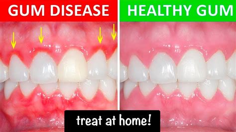 Gum Disease Treatment At Home Best Remedies Youtube