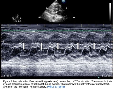 Dynamic Left Ventricular Outflow Tract Obstruction Underestimated