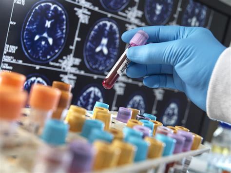 Advisory Council Releases Updates On Alzheimer Disease Treatments Research