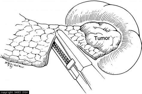 Distal Pancreatectomy With Splenectomy Sages Image Library