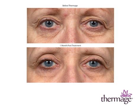 Patient 160931166 | Thermage FLX Before & After Photos | Jean Rhee, MD ...