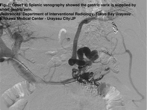 Figure From Eight Cases Of Endovascular Embolisation By Balloon