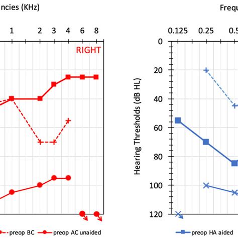 Audiometric Results Unaided Preoperative Air Conduction Ac And Bone Download Scientific