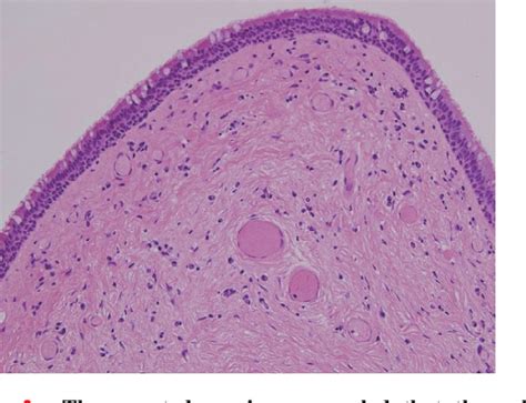 Fibroepithelial Polyp Histology