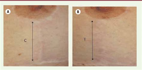 Traitement Par Laser Diode Nm Technique Lash Sein Cicatrice