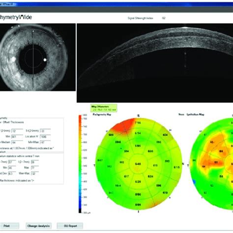 Comparison Of Epithelial Thickness Measurements Rtvue Sd Oct Device