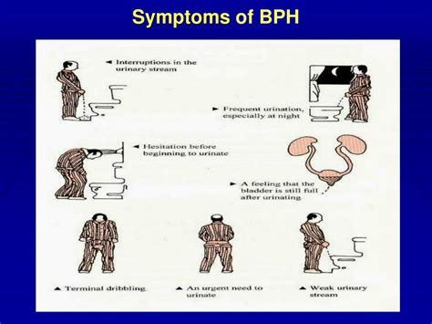 Ppt Benign Prostatic Hyperplasia Powerpoint Presentation Free Download Id6077435