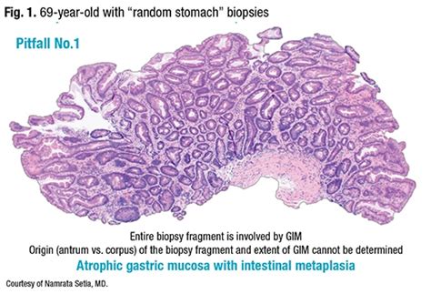 Gastric Intestinal Metaplasia—the Need To Classify And How Cap Today