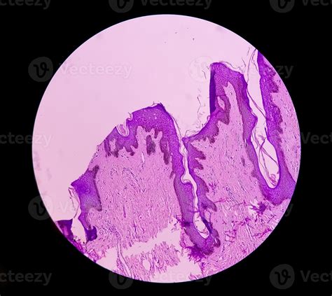 Histological Biopsy Of Scrotal Wall Under Microscopy Showing Calcinosis