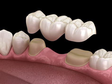 Todo Acerca De Los Puentes Dentales Quatre Dental