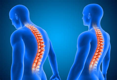 Escoliosis S Ntomas Causas Y Tratamientos