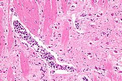 Intravascular large B-cell lymphoma - Libre Pathology