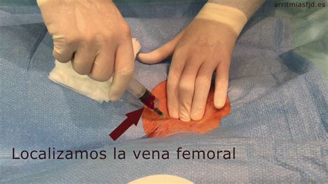 T Cnica De Punci N Femoral Venosa Youtube