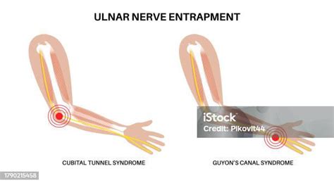 Ulnar Nerve Entrapment Stock Illustration Download Image Now Tunnel Arm Human Nervous