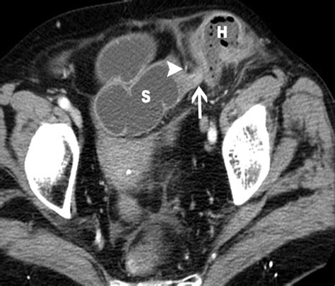 Small Bowel Obstruction What To Look For Radiographics