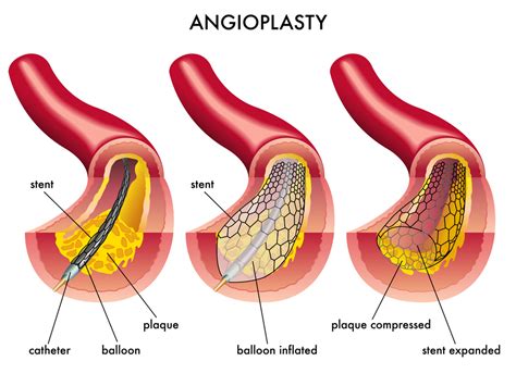 Balloon Angioplasty Procedure For Peripheral Artery Disease