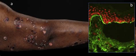 Autoimmune Blistering Skin Diseases Medicine