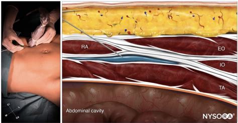 Bloc Du Plan Transverse De L Abdomen Tap Guid Par Ultrasons Nysora